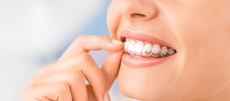 Invisalign in Fremont